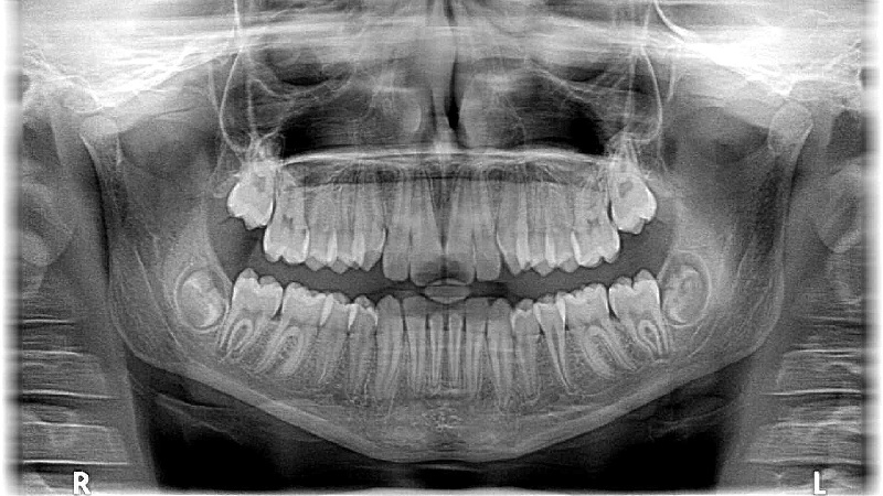 3D-Radiologie BOTOX® gegen Knirschen